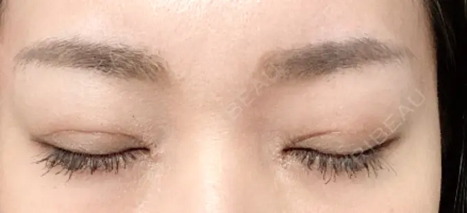 二重切開 / 目頭切開 心斎橋コムロ美容外科クリニック DAY 102 メイン用