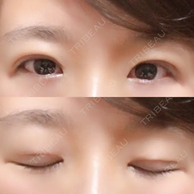 二重埋没 きくな湯田眼科 DAY 8 メイン用