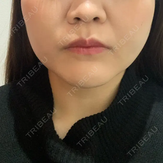 糸リフト / バッカルファット除去 / 脂肪吸引（顔） / メーラーファット除去 / ボトックス（エラ・小顔） 湘南美容クリニック 秋葉原院 DAY 39 メイン用