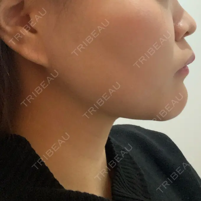 糸リフト / バッカルファット除去 / 脂肪吸引（顔） / メーラーファット除去 / ボトックス（エラ・小顔） 湘南美容クリニック 秋葉原院 DAY 39 メイン用