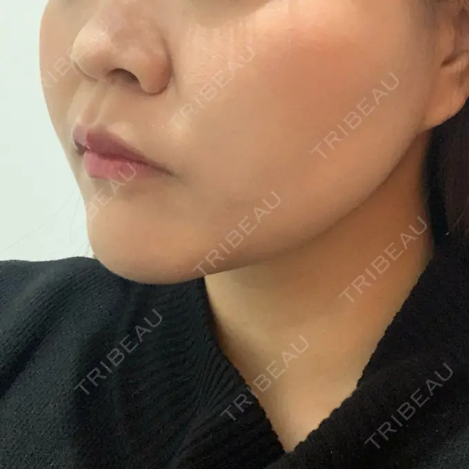 糸リフト / バッカルファット除去 / 脂肪吸引（顔） / メーラーファット除去 / ボトックス（エラ・小顔） 湘南美容クリニック 秋葉原院 DAY 39 メイン用