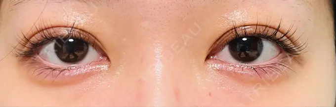 二重埋没 / ヒアルロン酸注入（目の下） EMMA CLINIC（エマクリニック） DAY 10 メイン用