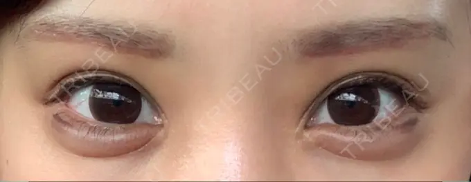 眉下切開 湘南美容クリニック 高田馬場院 DAY 13 メイン用