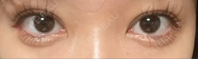 二重埋没 / ヒアルロン酸注入（目の下） EMMA CLINIC（エマクリニック） DAY 11 メイン用