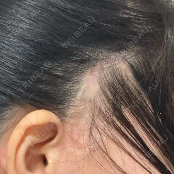 その他（肌） F5整形外科 DAY 368 メイン用