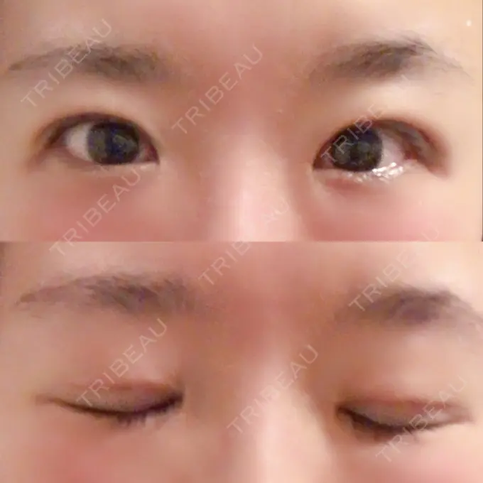 二重埋没 きくな湯田眼科 DAY 10 メイン用