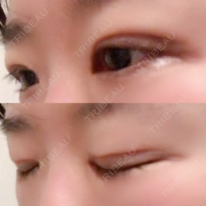 二重埋没 きくな湯田眼科 DAY 10 メイン用