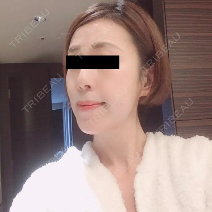 糸リフト / 脂肪吸引（顔） / 脂肪注入（肌） 湘南美容クリニック 秋葉原院 DAY 64 メイン用