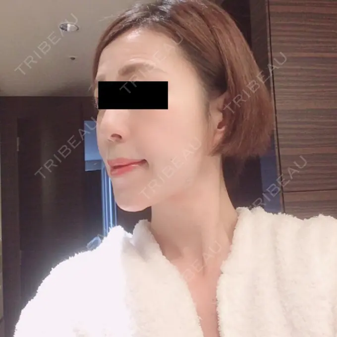 糸リフト / 脂肪吸引（顔） / 脂肪注入（肌） 湘南美容クリニック 秋葉原院 DAY 64 メイン用