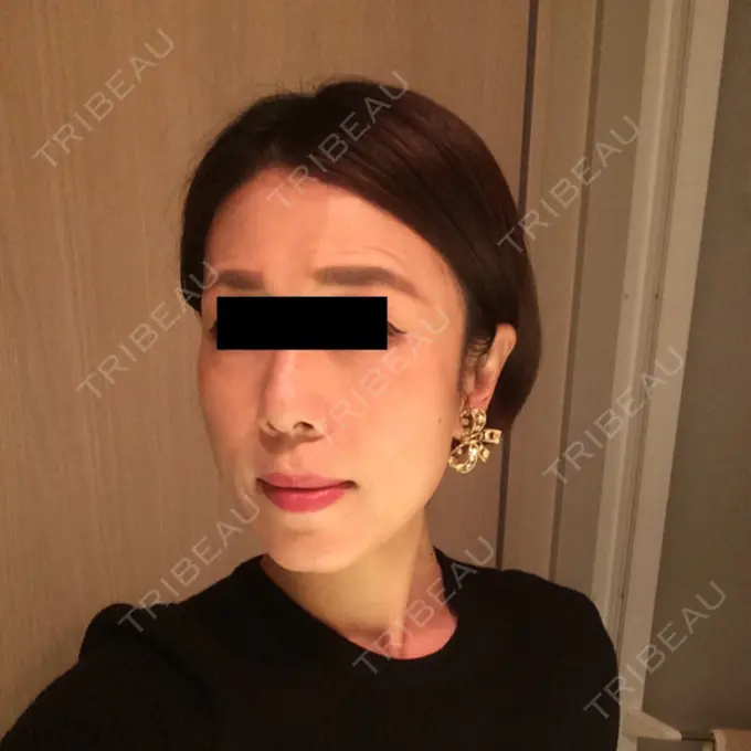 糸リフト / 脂肪吸引（顔） / 脂肪注入（肌） 湘南美容クリニック 秋葉原院 DAY 69 メイン用