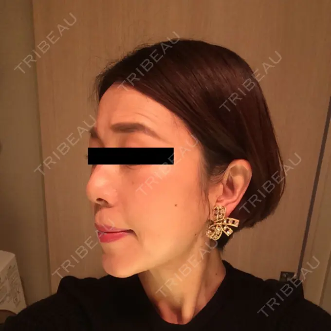 糸リフト / 脂肪吸引（顔） / 脂肪注入（肌） 湘南美容クリニック 秋葉原院 DAY 69 メイン用