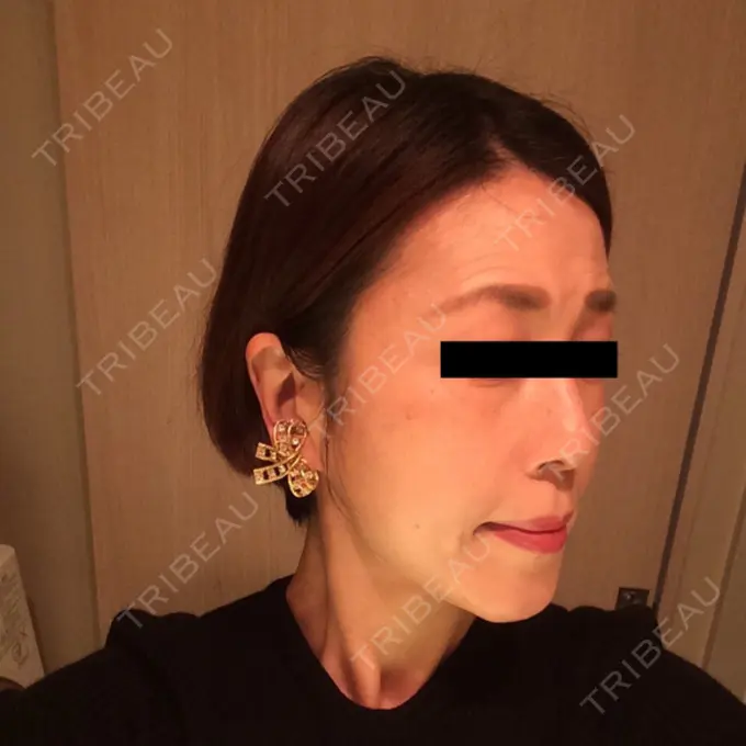 糸リフト / 脂肪吸引（顔） / 脂肪注入（肌） 湘南美容クリニック 秋葉原院 DAY 69 メイン用