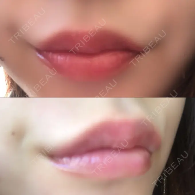人中短縮 / ヒアルロン酸注入（唇） / ボトックス（口角） ルラ美容クリニック 高田馬場院 DAY 23 メイン用