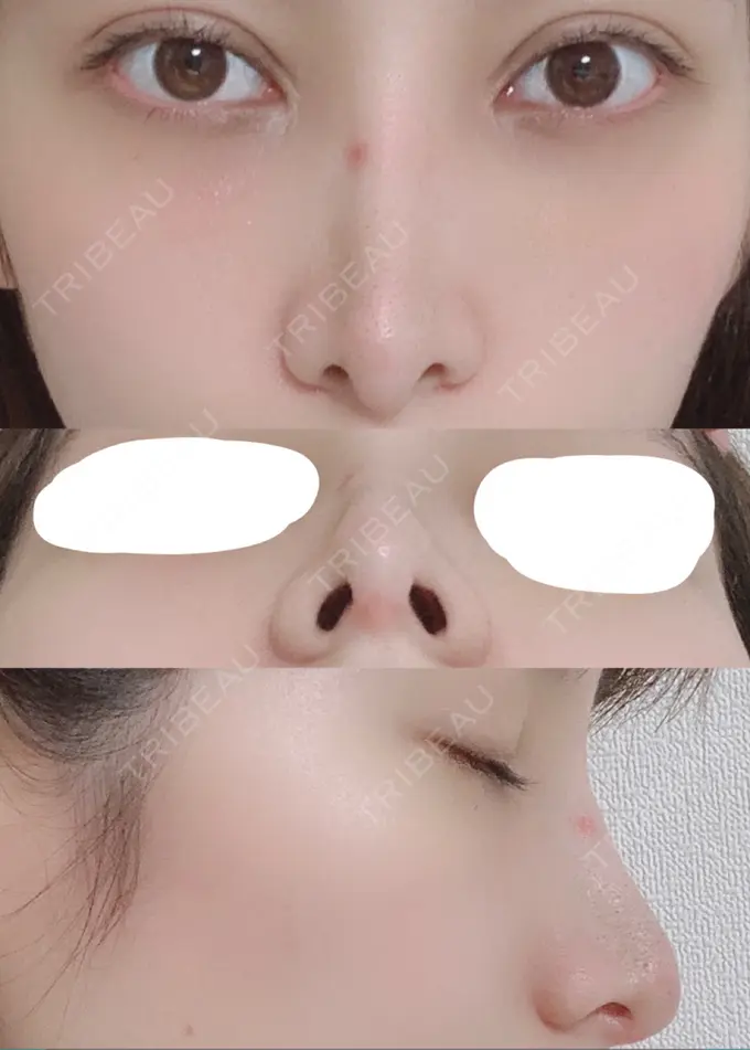 鼻尖形成（切開） / 鼻中隔延長（切開） / 骨切幅寄せ / 鼻修正 湘南美容クリニック 新橋銀座口院 DAY 22 メイン用