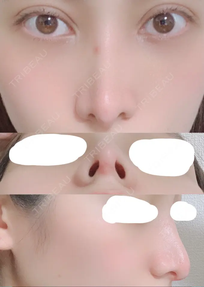 鼻尖形成（切開） / 鼻中隔延長（切開） / 骨切幅寄せ / 鼻修正 湘南美容クリニック 新橋銀座口院 DAY 23 メイン用