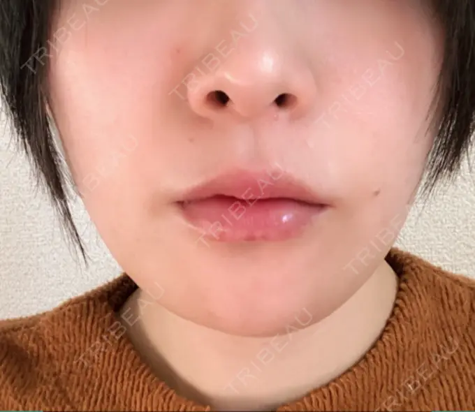 骨切り（あご） 仙台中央クリニック DAY 16 メイン用