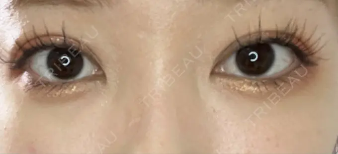 二重埋没 / ヒアルロン酸注入（目の下） EMMA CLINIC（エマクリニック） DAY 14 メイン用