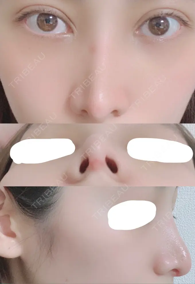 鼻尖形成（切開） / 鼻中隔延長（切開） / 骨切幅寄せ / 鼻修正 湘南美容クリニック 新橋銀座口院 DAY 24 メイン用