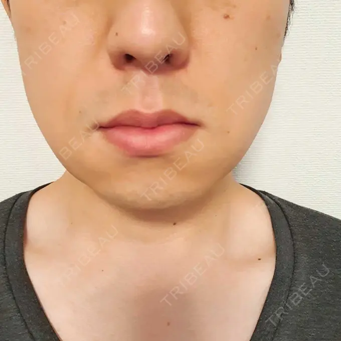 骨切り（あご） / 骨削り（エラ） 心斎橋コムロ美容外科クリニック DAY 25 メイン用