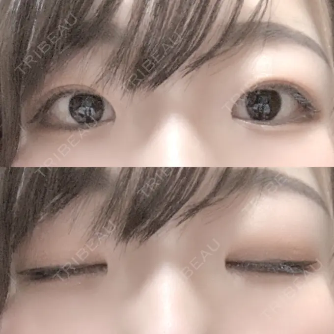 二重埋没 / 上まぶたの脂肪取り いわきタウン形成外科クリニック DAY 297 メイン用