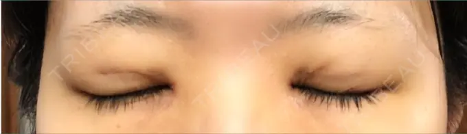 二重埋没 / 目頭切開 恵聖会クリニック 京橋院 DAY 12 メイン用