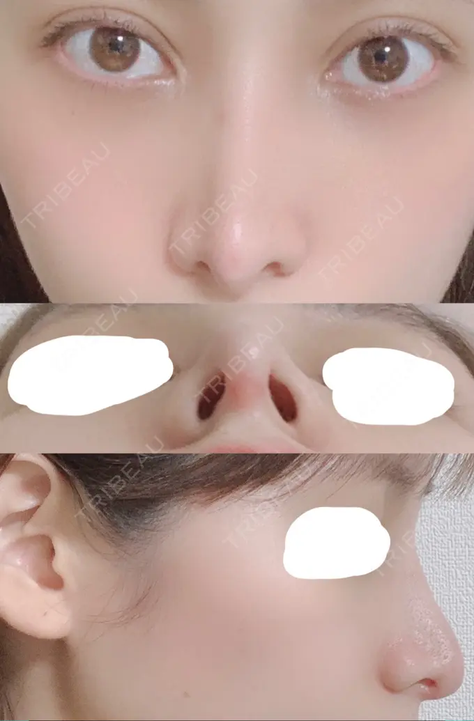 鼻尖形成（切開） / 鼻中隔延長（切開） / 骨切幅寄せ / 鼻修正 湘南美容クリニック 新橋銀座口院 DAY 25 メイン用