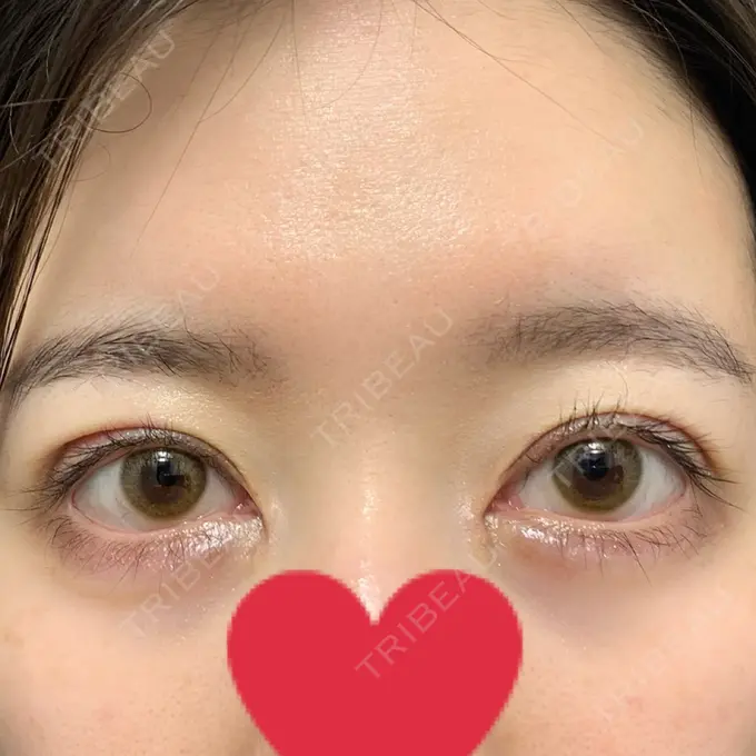 二重切開 / 目頭切開 心斎橋コムロ美容外科クリニック DAY 14 メイン用