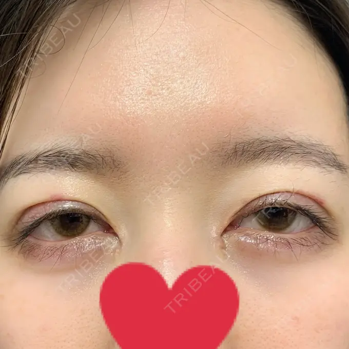 二重切開 / 目頭切開 心斎橋コムロ美容外科クリニック DAY 14 メイン用