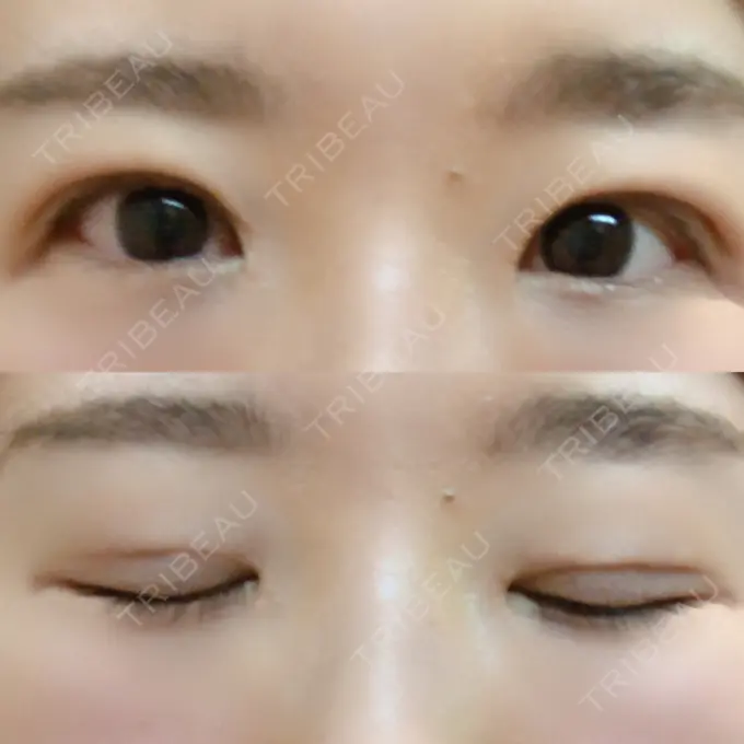 二重埋没 きくな湯田眼科 DAY 14 メイン用