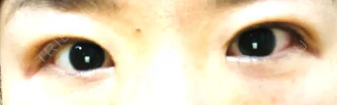 二重埋没 きくな湯田眼科 DAY 14 メイン用