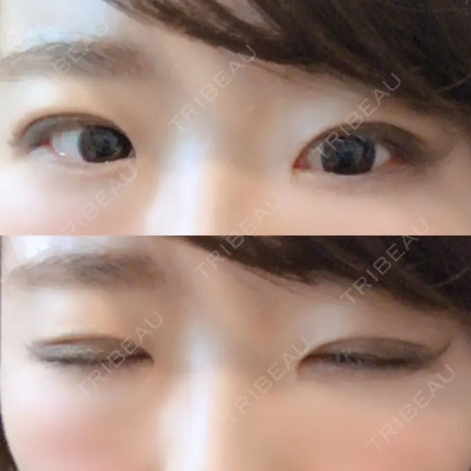 二重埋没 きくな湯田眼科 DAY 13 メイン用