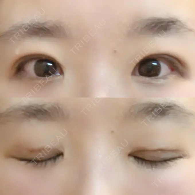 二重埋没 きくな湯田眼科 DAY 13 メイン用