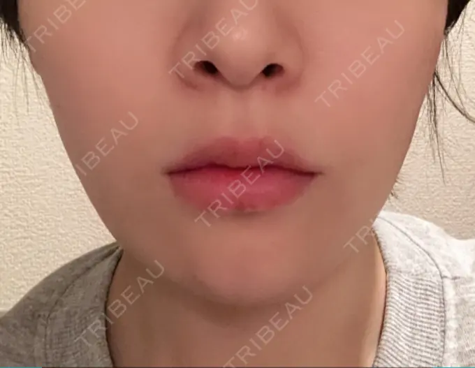 骨切り（あご） 仙台中央クリニック DAY 18 メイン用