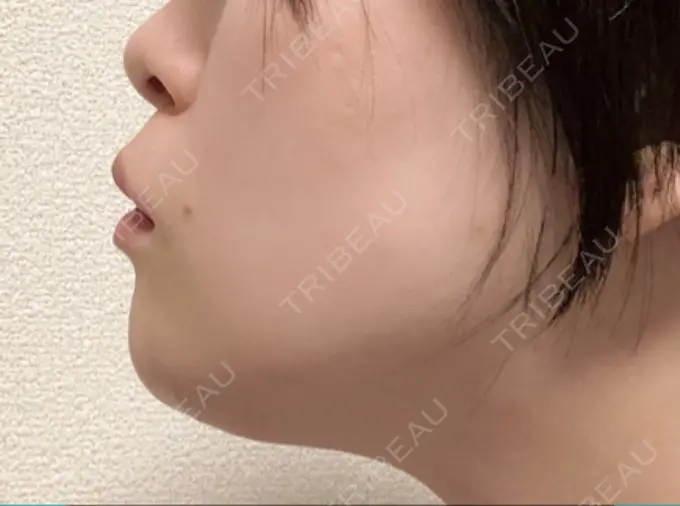 骨切り（あご） 仙台中央クリニック DAY 18 メイン用