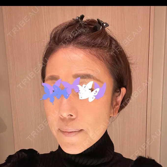 糸リフト / 脂肪吸引（顔） / 脂肪注入（肌） 湘南美容クリニック 秋葉原院 DAY 74 メイン用