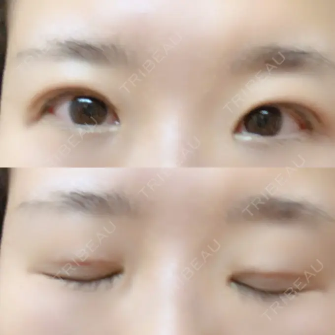 二重埋没 きくな湯田眼科 DAY 15 メイン用