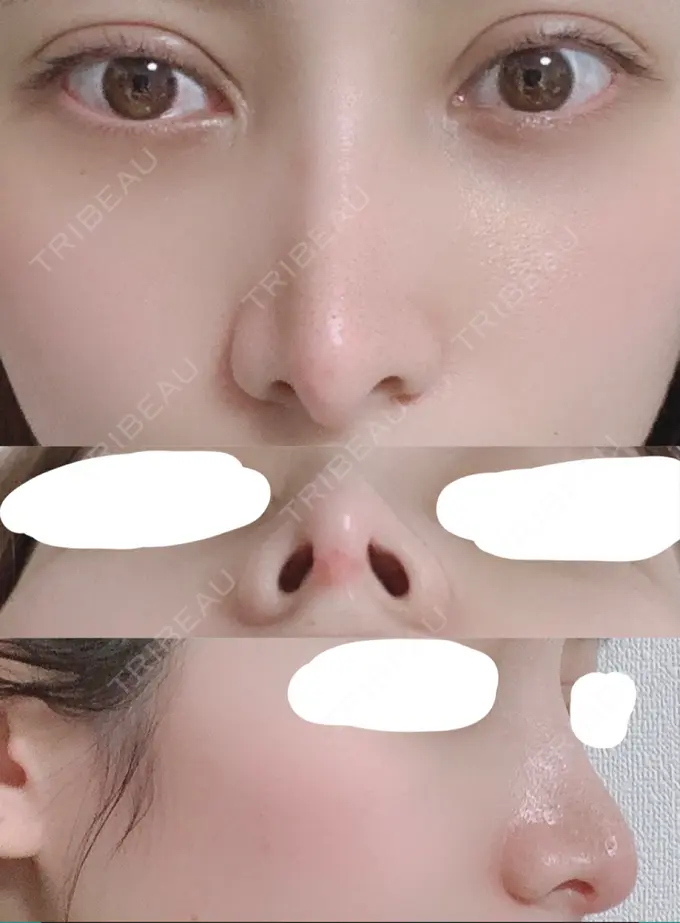 鼻尖形成（切開） / 鼻中隔延長（切開） / 骨切幅寄せ / 鼻修正 湘南美容クリニック 新橋銀座口院 DAY 26 メイン用