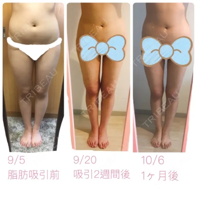脂肪吸引（脚） / 脂肪吸引（お腹） / 脂肪吸引（お尻） ヨンセスリムライン DAY 30 メイン用