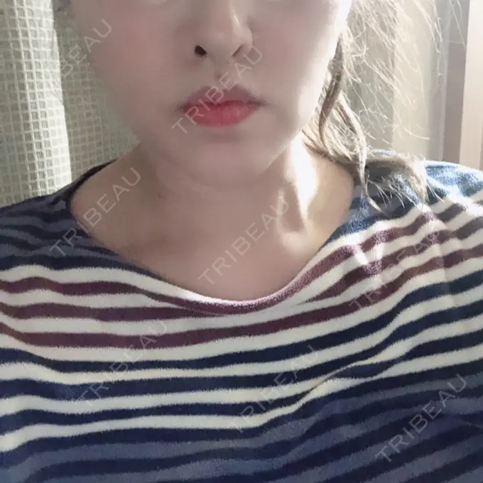 脂肪溶解注射（顔） 赤坂プレミアクリニック AFTER メイン用