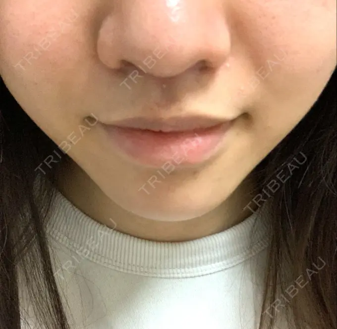 人中短縮 新宿ラクル美容外科クリニック 新宿院 DAY 33 メイン用