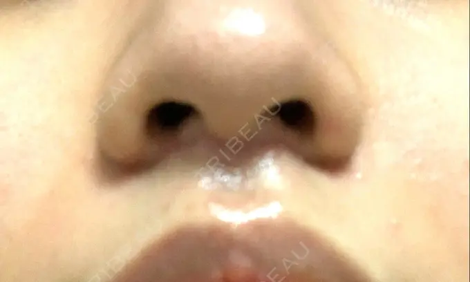 人中短縮 新宿ラクル美容外科クリニック 新宿院 DAY 33 メイン用