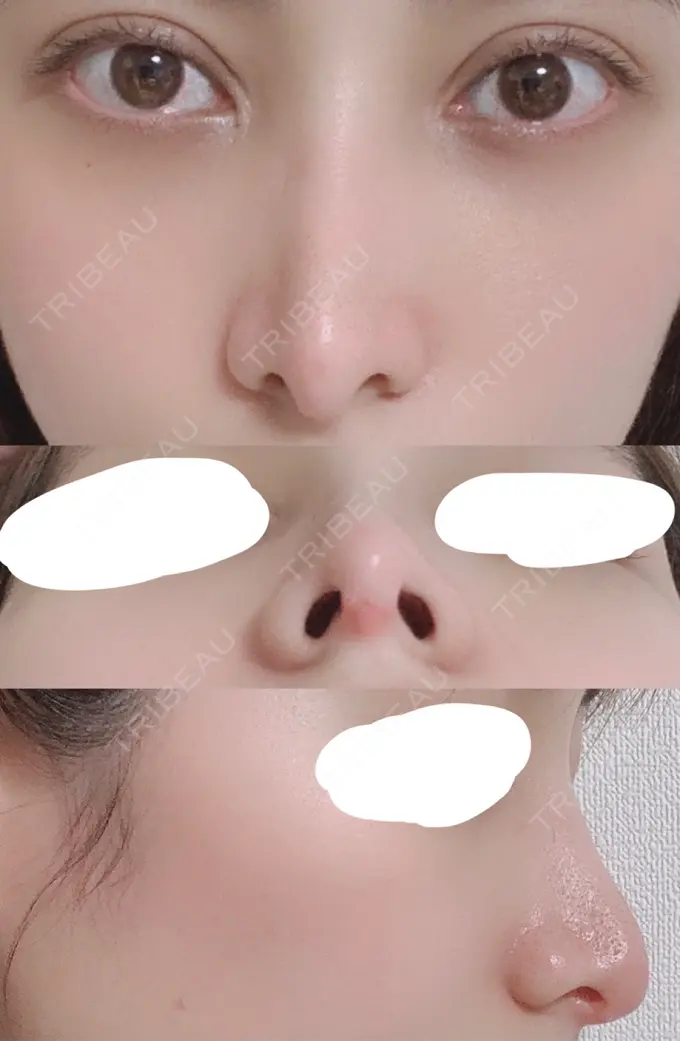 鼻尖形成（切開） / 鼻中隔延長（切開） / 骨切幅寄せ / 鼻修正 湘南美容クリニック 新橋銀座口院 DAY 27 メイン用