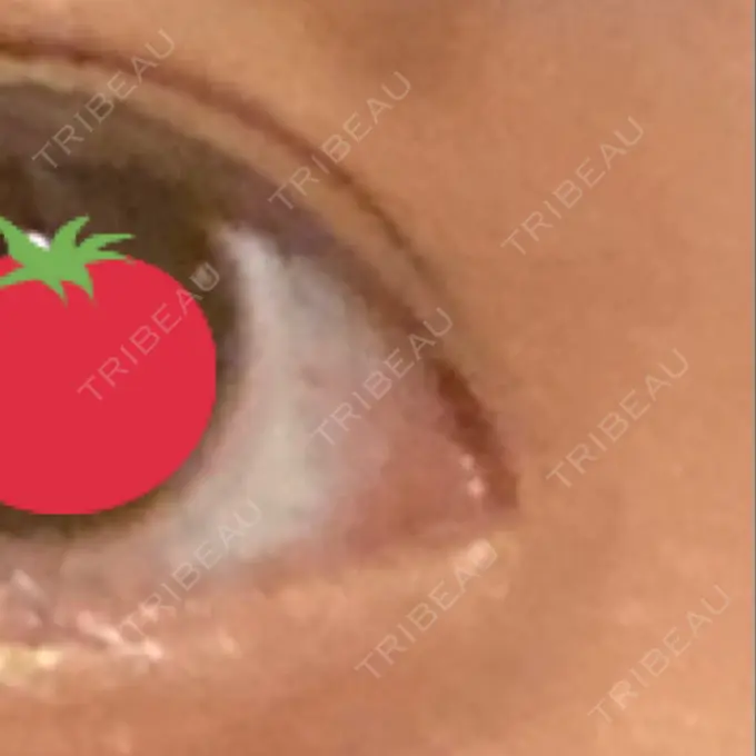 二重埋没 / 目頭切開 ドクター松井クリニック 新宿 DAY 35 メイン用