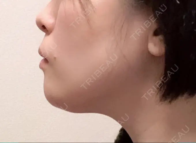 骨切り（あご） 仙台中央クリニック DAY 21 メイン用