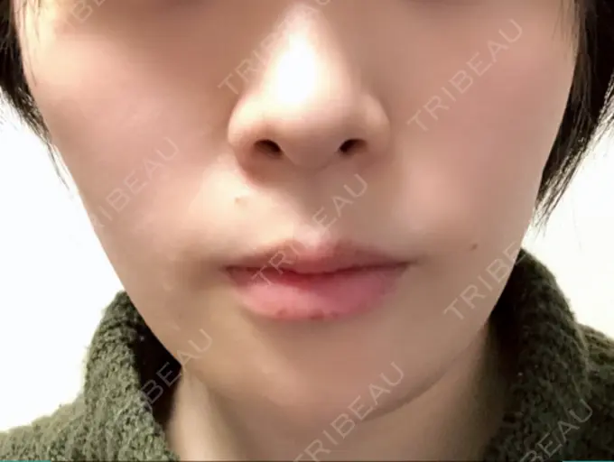 骨切り（あご） 仙台中央クリニック DAY 21 メイン用