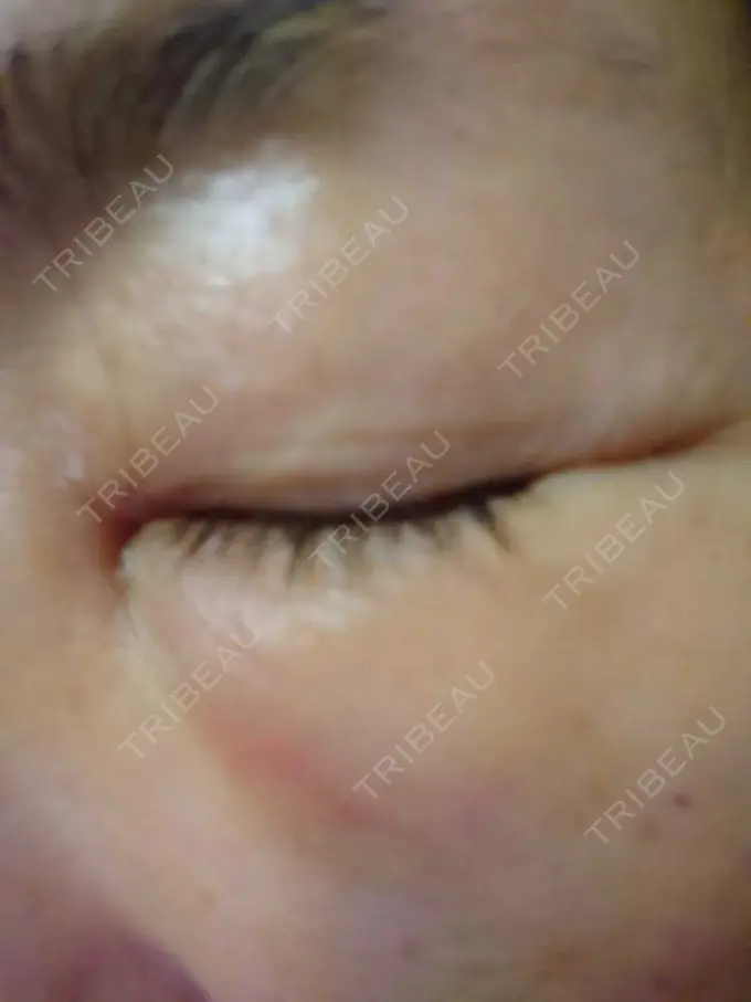 下まぶたたるみ取り / その他 湘南美容クリニック 千葉センシティ院 DAY 2 メイン用