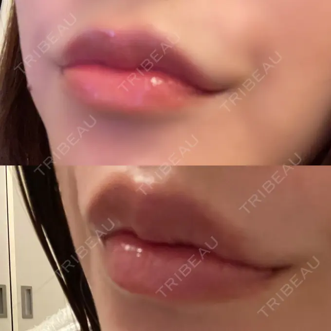 人中短縮 / ヒアルロン酸注入（唇） / ボトックス（口角） ルラ美容クリニック 高田馬場院 DAY 31 メイン用