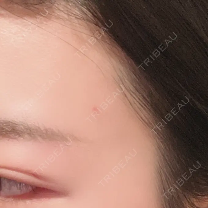 ほくろ・いぼ切除（肌） 品川スキンクリニック大宮院 DAY 12 メイン用