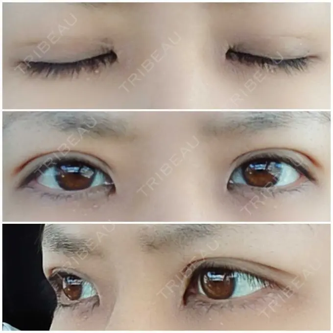 二重埋没 かわた美容クリニック DAY 26 メイン用