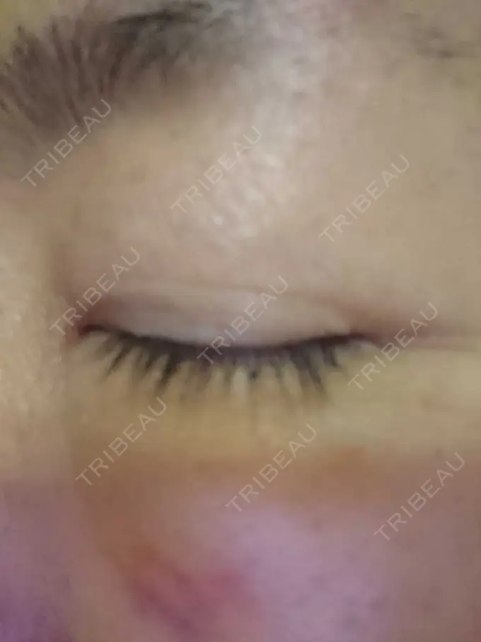 下まぶたたるみ取り / その他 湘南美容クリニック 千葉センシティ院 DAY 4 メイン用